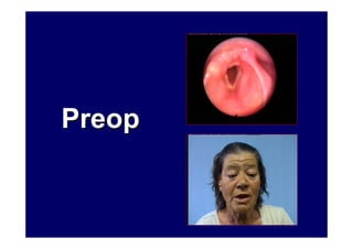 PreopPreop
 