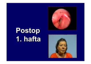 PostopPostop
1. hafta1. hafta
 