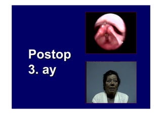 PostopPostop
3. ay3. ay
 