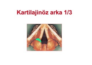 KartilajinKartilajinöözz arka 1/3arka 1/3
 