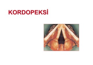 KORDOPEKSKORDOPEKS
 