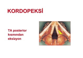 KORDOPEKSKORDOPEKS
TATA posteriorposterior
kk smsm ndanndan
eksizyoneksizyon
 