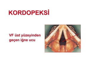 KORDOPEKSKORDOPEKS
VFVF üüst yst yüüzeyindenzeyinden
gegeççen ien i ne ucune ucu
 