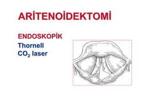 ENDOSKOPENDOSKOP KK
ThornellThornell
COCO22 laserlaser
ARAR TENOTENO DEKTOMDEKTOM
 