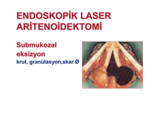 ENDOSKOPENDOSKOP K LASERK LASER
ARAR TENOTENO DEKTOMDEKTOM
SubmukozalSubmukozal
eksizyoneksizyon
krutkrut,, grangranüülasyonlasyon,,skarskar ØØ
 