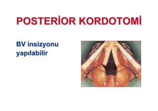 POSTERPOSTER OR KORDOTOMOR KORDOTOM
BVBV insizyonuinsizyonu
yapyap labilirlabilir
 