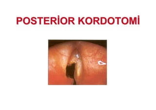 POSTERPOSTER OR KORDOTOMOR KORDOTOM
 