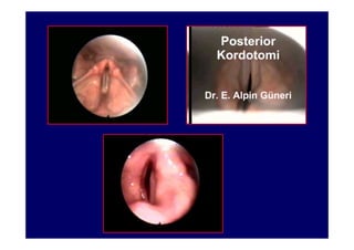 Ses kısıklığı tanı ve tedavi