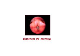 BilateralBilateral VFVF atrofisiatrofisi
 
