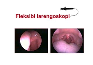 FleFleksiblksibl larlarengoskopiengoskopi
 