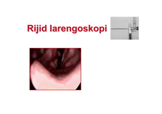 RijidRijid larlarengoskopiengoskopi
 
