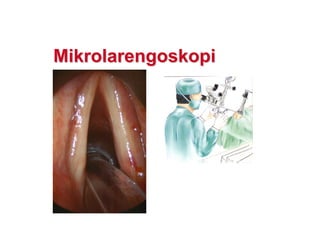 MikrolarengoskopiMikrolarengoskopi
 