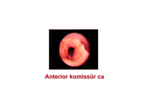 AnteriorAnterior komisskomissüürr caca
 