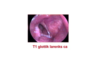 T1T1 glottikglottik larenkslarenks caca
 