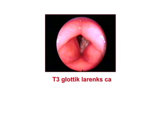 T3T3 glottikglottik larenkslarenks caca
 