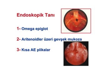 Endoskopik TanEndoskopik Tan
11-- OmegaOmega epiglotepiglot
22-- AritenoidlerAritenoidler üüzeri gevzeri gev((ek mukozaek mukoza
33-- KK sa AEsa AE plikalarplikalar
 