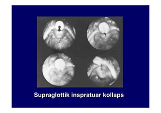 SupraglottikSupraglottik inspratuarinspratuar kollapskollaps
 