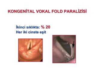 KONGENKONGEN TAL VOKAL FOLD PARALTAL VOKAL FOLD PARAL ZZ SS
kinci skinci s klkl kta:kta: % 20% 20
Her iki cinste eHer iki cinste e((itit
 