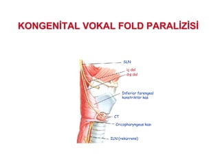 SLN
iç dal
d $ dal
%nferior farengeal
konstriktör kas
CT
Cricopharyngeus kas
ILN (rekürrens)
KONGENKONGEN TAL VOKAL FOLD PARALTAL VOKAL FOLD PARAL ZZ SS
 