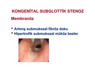 MembranMembranöözz
•• ArtmArtm (( submukozalsubmukozal fibrfibröözz dokudoku
•• HipertrofikHipertrofik submukozalsubmukozal mmüükköözz bezlerbezler
KONGENKONGEN TAL SUBGLOTTTAL SUBGLOTT K STENOZK STENOZ
 