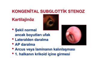 KartilajinKartilajinöözz
•• 77ekil normalekil normal
ancak boyutlarancak boyutlar ufakufak
•• LateraldenLateralden daralmadaralma
•• AP daralmaAP daralma
•• ArcusArcus veyaveya laminanlaminan nn kalkal nlanla((masmas
•• 1. halkan1. halkan nn krikoidkrikoid iiççine girmesiine girmesi
KONGENKONGEN TAL SUBGLOTTTAL SUBGLOTT K STENOZK STENOZ
 