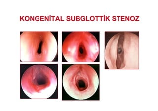 KONGENKONGEN TAL SUBGLOTTTAL SUBGLOTT K STENOZK STENOZ
 