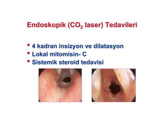 Endoskopik (COEndoskopik (CO22 laserlaser) Tedavileri) Tedavileri
•• 4 kadran4 kadran insizyoninsizyon veve dilatasyondilatasyon
•• LokalLokal mitomisinmitomisin-- CC
•• SistemikSistemik steroidsteroid tedavisitedavisi
 