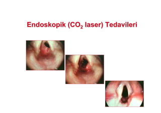 Endoskopik (COEndoskopik (CO22 laserlaser) Tedavileri) Tedavileri
 
