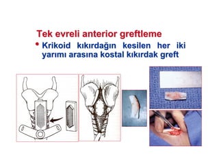 Tek evreliTek evreli anterioranterior greftlemegreftleme
•• KrikoidKrikoid kk kk rdarda n kesilen her ikin kesilen her iki
yaryar mm arasaras nana kostalkostal kk kk rdakrdak greftgreft
 