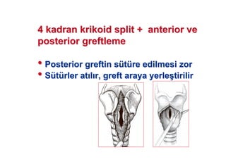 4 kadran4 kadran krikoidkrikoid splitsplit ++ anterioranterior veve
posteriorposterior greftlemegreftleme
•• PosteriorPosterior greftingreftin ssüüttüürere edilmesi zoredilmesi zor
•• SSüüttüürlerrler atat ll r,r, greftgreft araya yerlearaya yerle((tirilirtirilir
 