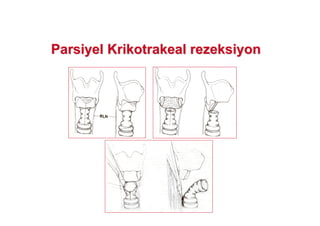 ParsiyelParsiyel KrikotrakealKrikotrakeal rezeksiyonrezeksiyon
 