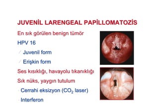 En sEn s k gk göörrüülenlen benignbenign ttüümmöörr
HPV 16HPV 16
JuvenilJuvenil formform
EriEri##kin formkin form
Ses kSes k ss klkl !! , havayolu t, havayolu t kankan klkl !!
SS kk nnüüksks, yayg, yayg n tutulumn tutulum
•• CerrahiCerrahi eksizyoneksizyon (CO(CO22 laserlaser))
•• InterferonInterferon
JUVENJUVEN L LARENGEAL PAPL LARENGEAL PAP LLOMATOZLLOMATOZ SS
 