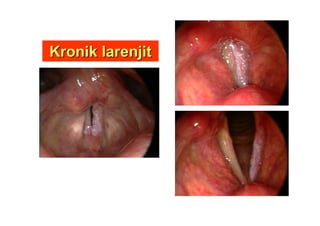 Kronik larenjitKronik larenjit
 