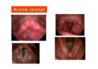 Kronik larenjitKronik larenjit
 