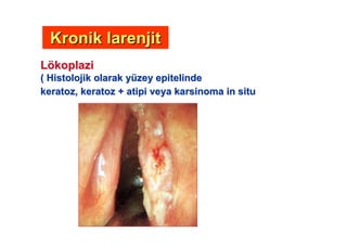 LLöökoplazikoplazi
( Histolojik olarak y( Histolojik olarak yüüzeyzey epitelindeepitelinde
keratozkeratoz,, keratozkeratoz ++ atipiatipi veyaveya karsinomakarsinoma inin situsitu
Kronik larenjitKronik larenjit
 