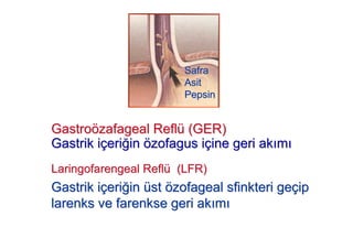 GastroGastroöözafagealzafageal ReflReflüü (GER)(GER)
GastrikGastrik iiççerieri!!inin öözofaguszofagus iiççine geri akine geri ak mm
LaringofarengealLaringofarengeal ReflReflüü (LFR)(LFR)
GastrikGastrik iiççerieri!!inin üüstst öözofagealzofageal sfinkterisfinkteri gegeççipip
larenkslarenks veve farenksefarenkse geri akgeri ak mm
SafraSafra
AsitAsit
PepsinPepsin
 
