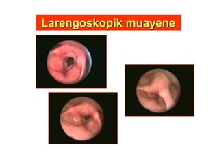 LarengoskopikLarengoskopik muayenemuayene
 