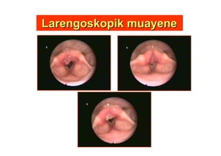 LarengoskopikLarengoskopik muayenemuayene
 