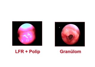 LFR + PolipLFR + Polip GranGranüülomlom
 