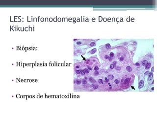 LES: Linfonodomegalia e Doença de
Kikuchi
• Biópsia:
• Hiperplasia folicular
• Necrose
• Corpos de hematoxilina

 