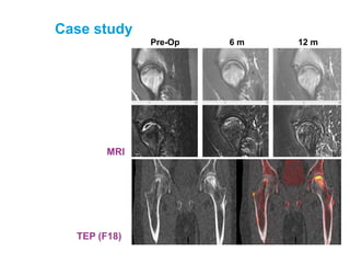 Case study
TEP (F18)
Pre-Op 6 m 12 m
MRI
 