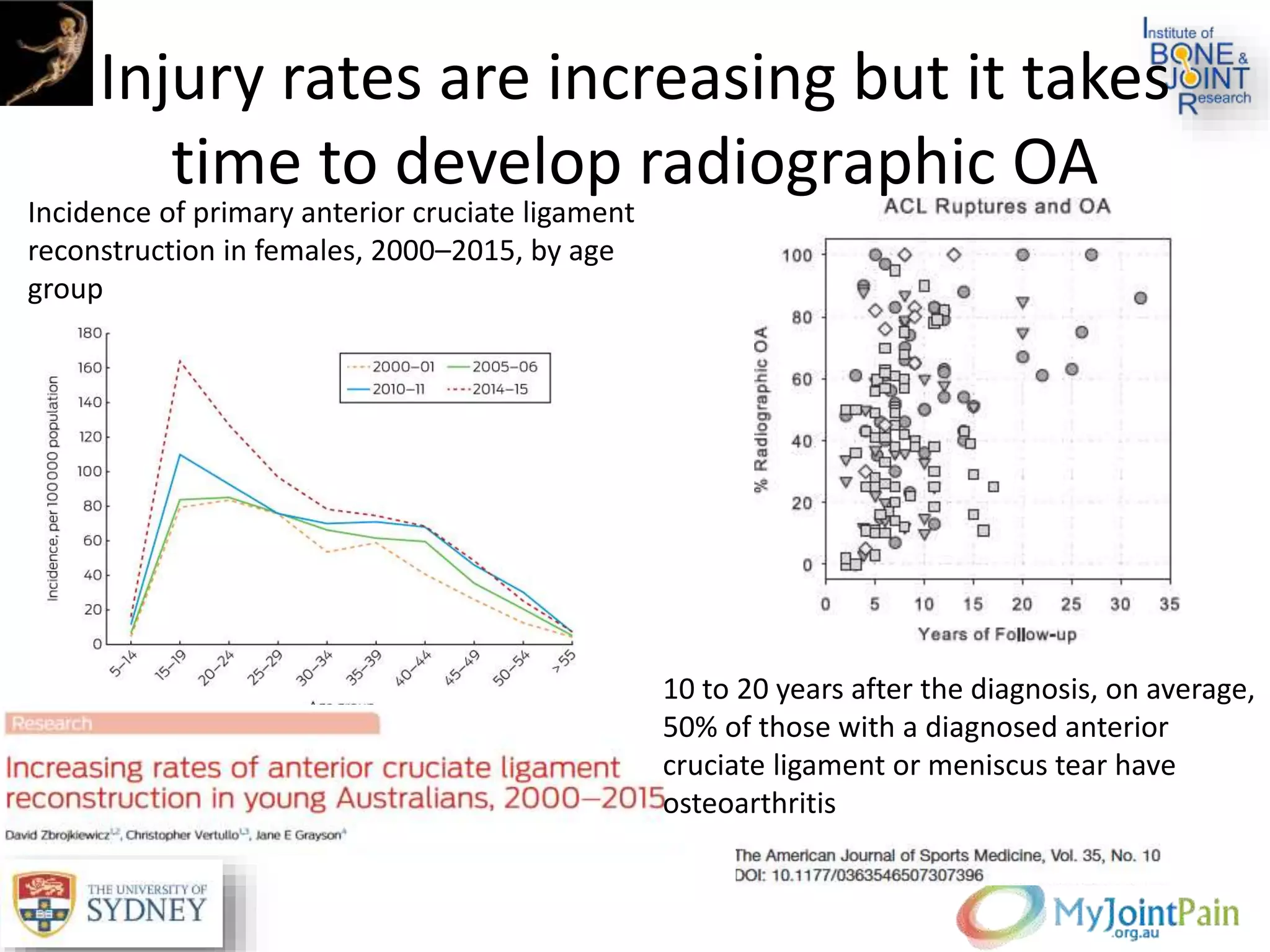 Injury rates are increasing but it takes
time to develop radiographic OA
Incidence of primary anterior cruciate ligament
reconstruction in females, 2000–2015, by age
group
10 to 20 years after the diagnosis, on average,
50% of those with a diagnosed anterior
cruciate ligament or meniscus tear have
osteoarthritis
 