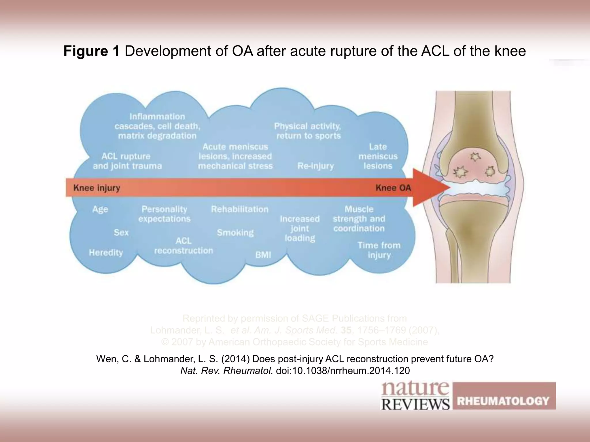 Figure 1 Development of OA after acute rupture of the ACL of the knee
Wen, C. & Lohmander, L. S. (2014) Does post-injury ACL reconstruction prevent future OA?
Nat. Rev. Rheumatol. doi:10.1038/nrrheum.2014.120
Reprinted by permission of SAGE Publications from
Lohmander, L. S. et al. Am. J. Sports Med. 35, 1756–1769 (2007),
© 2007 by American Orthopaedic Society for Sports Medicine
 