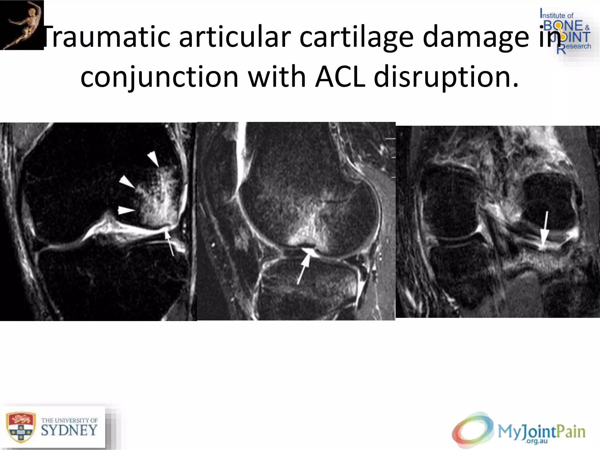 Traumatic articular cartilage damage in
conjunction with ACL disruption.
 