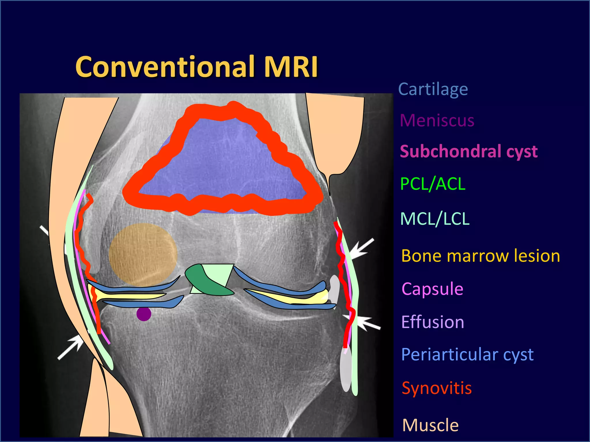 Meniscus
Subchondral cyst
Bone marrow lesion
Effusion
Muscle
PCL/ACL
MCL/LCL
Capsule
Periarticular cyst
Synovitis
Cartilage
Conventional MRI
 