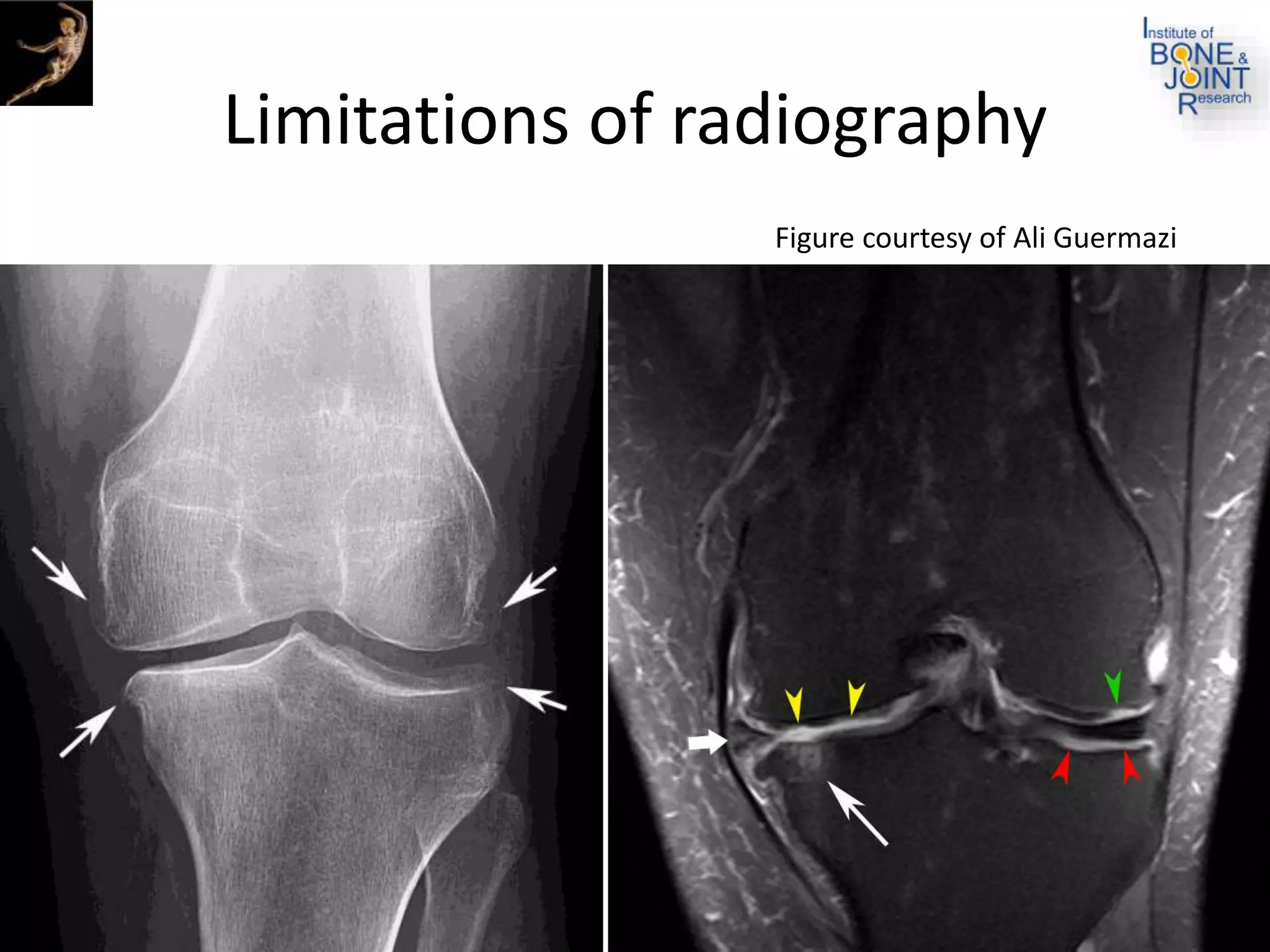 Limitations of radiography
Figure courtesy of Ali Guermazi
 