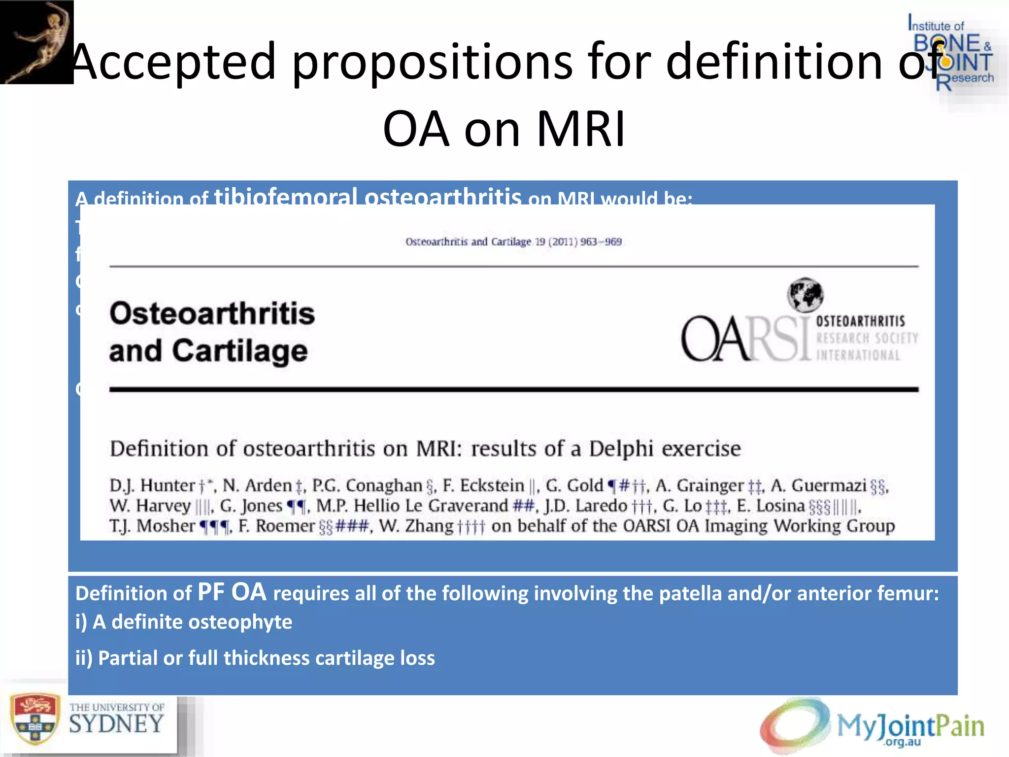 Accepted propositions for definition of
OA on MRI
A definition of tibiofemoral osteoarthritis on MRI would be:
The presence of both group [A] features or one group [A] feature and two or more group [B]
features
Group [A] after exclusion of joint trauma within the last 6 months (by history) and exclusion
of inflammatory arthritis (by radiographs, history and laboratory parameters):
i) Definite osteophyte formation§
ii) Full thickness cartilage loss
Group [B]:
i) Subchondral bone marrow lesion or cyst not associated with meniscal or ligamentous
attachments
ii) Meniscal subluxation, maceration or degenerative (horizontal) tear
iii) Partial thickness cartilage loss (where full thickness loss is not present)
iv) Bone attrition
Definition of PF OA requires all of the following involving the patella and/or anterior femur:
i) A definite osteophyte
ii) Partial or full thickness cartilage loss
 