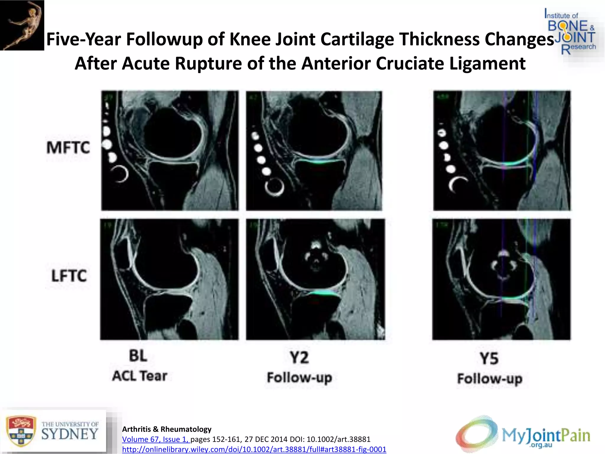 Five‐Year Followup of Knee Joint Cartilage Thickness Changes
After Acute Rupture of the Anterior Cruciate Ligament
Arthritis & Rheumatology
Volume 67, Issue 1, pages 152-161, 27 DEC 2014 DOI: 10.1002/art.38881
http://onlinelibrary.wiley.com/doi/10.1002/art.38881/full#art38881-fig-0001
 