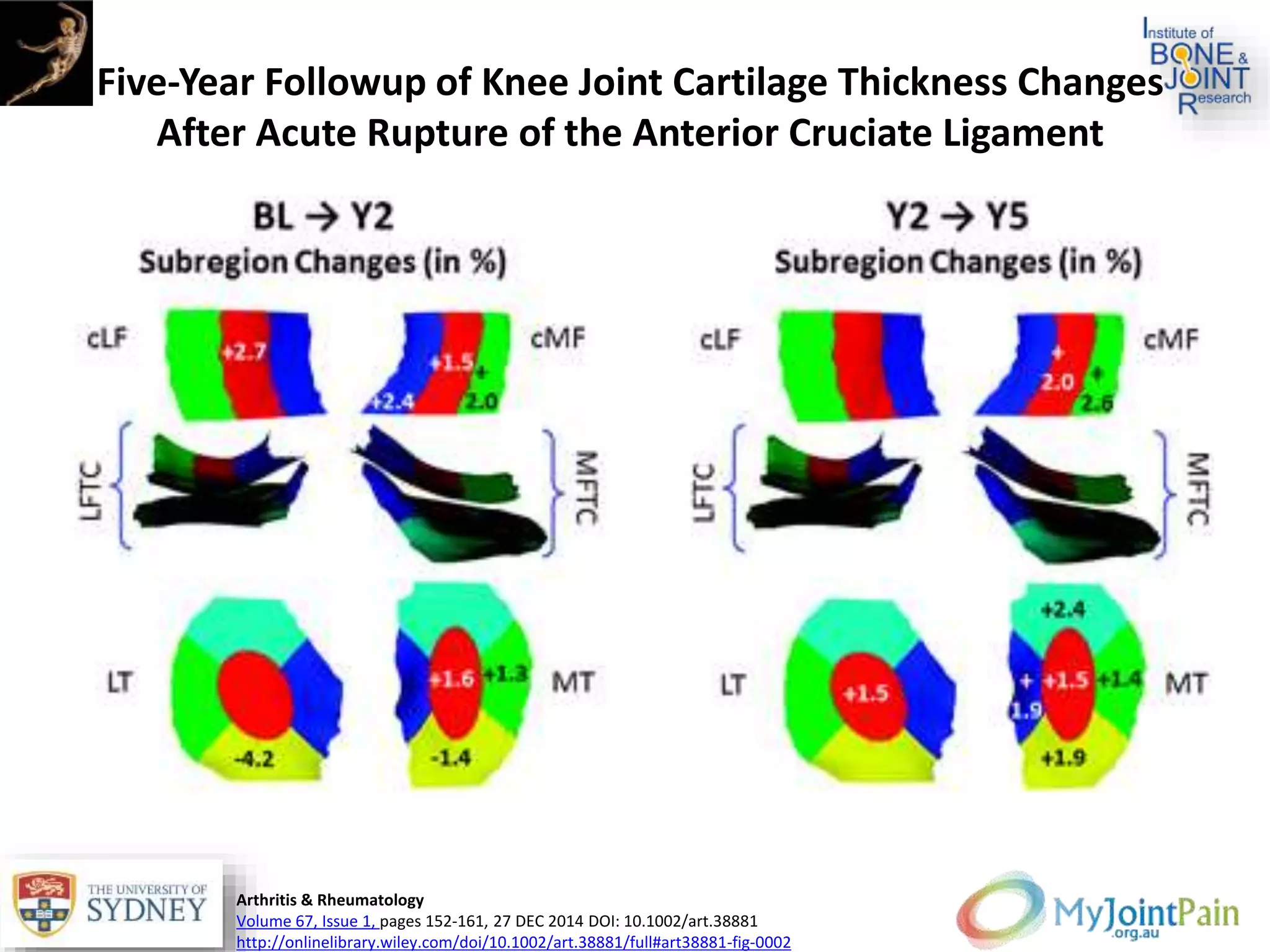 Five‐Year Followup of Knee Joint Cartilage Thickness Changes
After Acute Rupture of the Anterior Cruciate Ligament
Arthritis & Rheumatology
Volume 67, Issue 1, pages 152-161, 27 DEC 2014 DOI: 10.1002/art.38881
http://onlinelibrary.wiley.com/doi/10.1002/art.38881/full#art38881-fig-0002
 