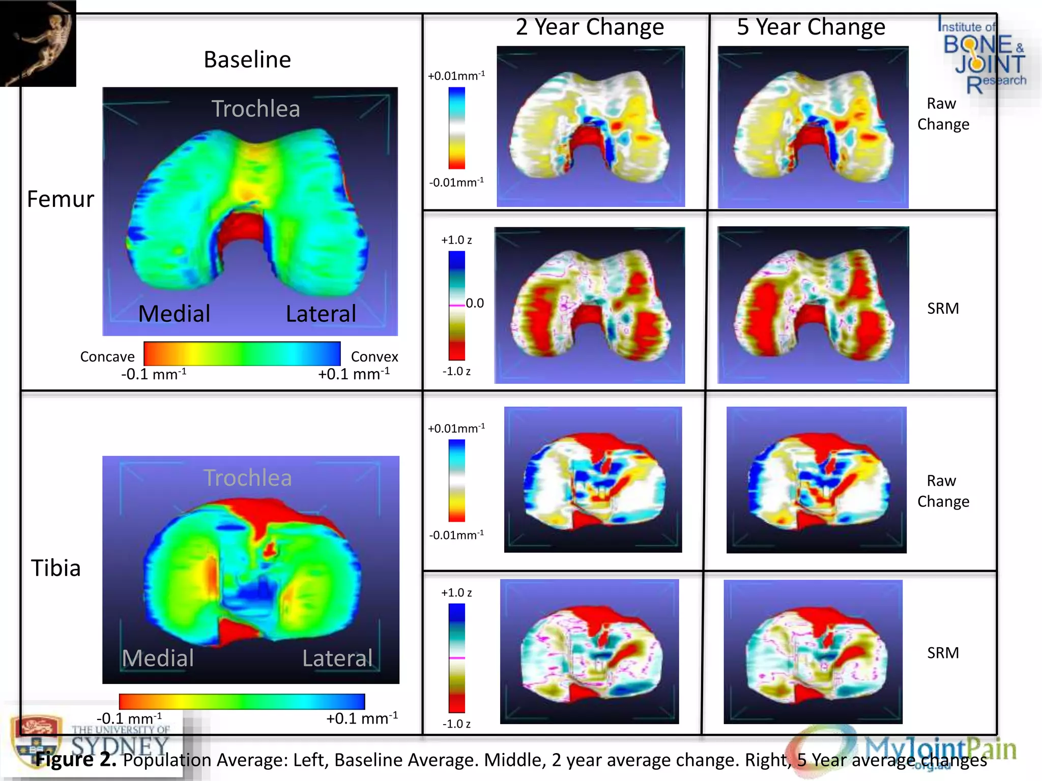 LateralMedial
Trochlea
LateralMedial
Trochlea
Femur
Tibia
Baseline
2 Year Change 5 Year Change
Raw
Change
SRM
Raw
Change
SRM
-0.1 mm-1 +0.1 mm-1
-0.1 mm-1 +0.1 mm-1
-0.01mm-1
+0.01mm-1
-1.0 z
+1.0 z
-0.01mm-1
+0.01mm-1
-1.0 z
+1.0 z
Concave Convex
Figure 2. Population Average: Left, Baseline Average. Middle, 2 year average change. Right, 5 Year average changes
0.0
 
